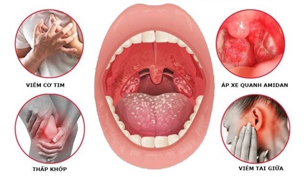 Viêm amidan hốc mủ có nên cắt không: Giải đáp từ chuyên gia