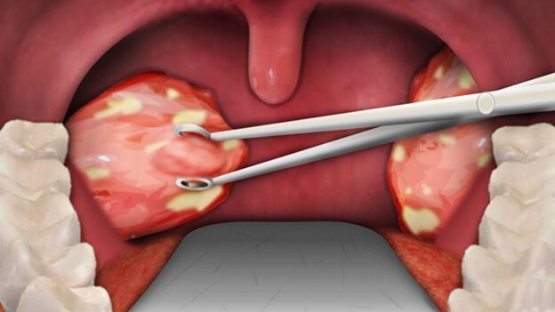 Viêm amidan hốc mủ có nên cắt không: Giải đáp từ chuyên gia