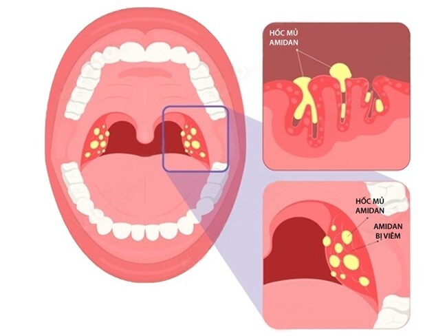 Viêm amidan hốc mủ có nên cắt không: Giải đáp từ chuyên gia