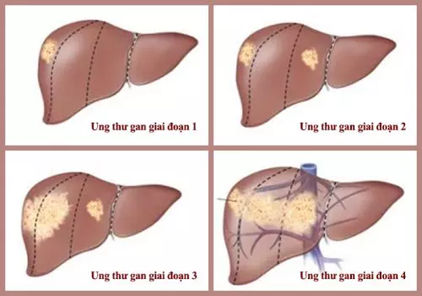 Ung thư gan giai đoạn 2: Những điều bệnh nhân cần đặc biệt lưu ý