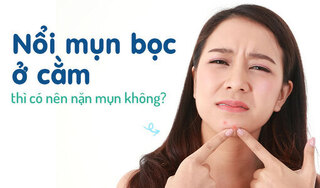 Nổi mụn bọc ở cằm thì có nên nặn mụn không?