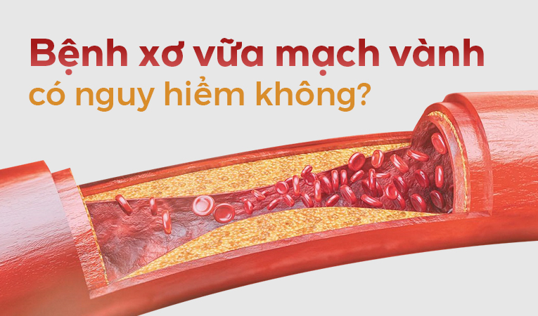 Tư vấn: Bệnh xơ vữa mạch vành có nguy hiểm không?