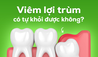 Hỏi nhanh đáp gọn: Viêm lợi trùm có tự khỏi được không?