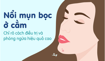 Nổi mụn bọc ở cằm: Chỉ rõ cách điều trị và phòng ngừa hiệu quả cao