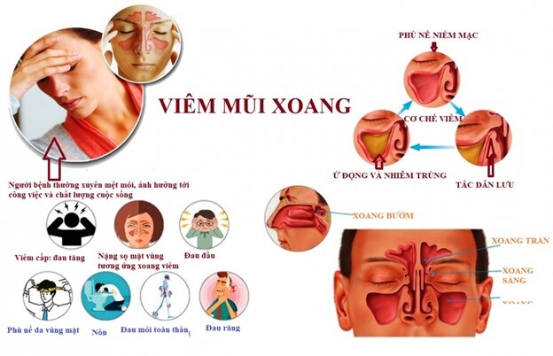 Bị viêm xoang có nên ăn thịt bò không? Giải đáp từ chuyên gia