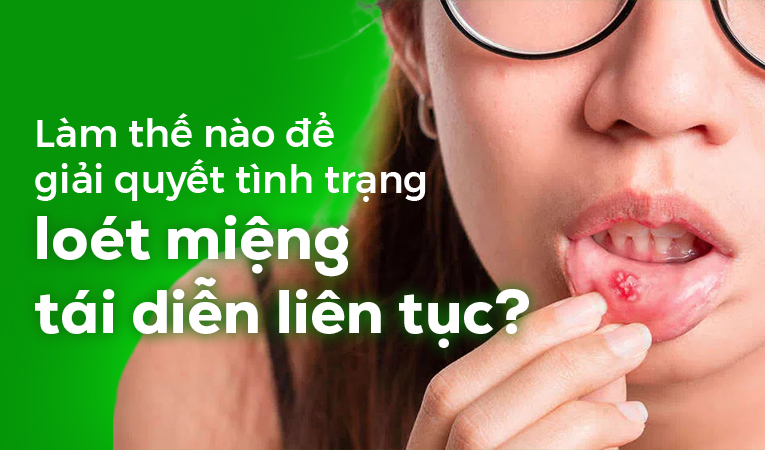 Làm thế nào để giải quyết tình trạng loét miệng tái diễn liên tục?