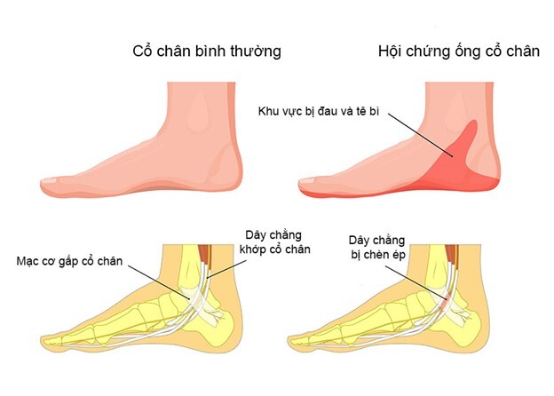 Đau xương gót chân là bệnh gì? Các biện pháp điều trị đau gót chân