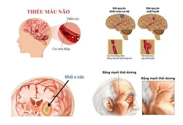 Đau nửa đầu bên phải: Cách điều trị ai cũng cần!