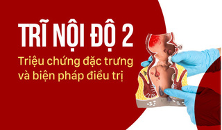 Trĩ nội độ 2: Triệu chứng đặc trưng và biện pháp điều trị