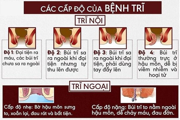 Các bài tập co búi trĩ đơn giản và dễ dàng thực hiện tại nhà