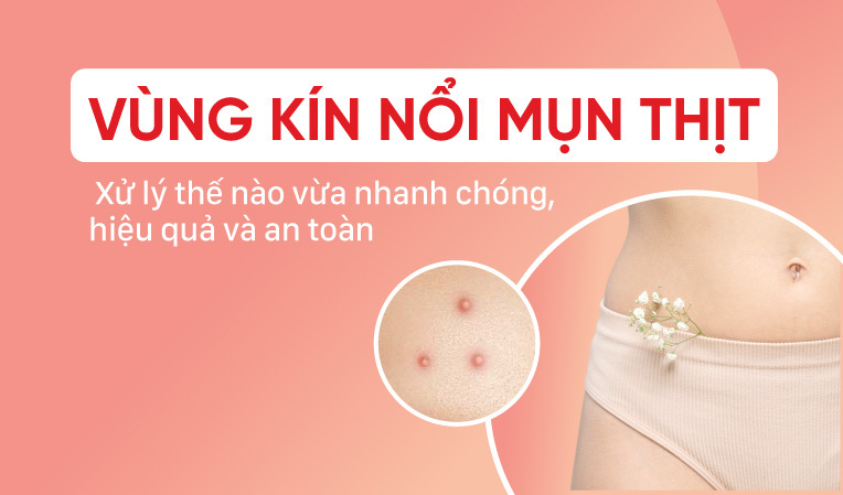 Vùng kín nổi mụn thịt: Hướng dẫn cách xử trí nhanh