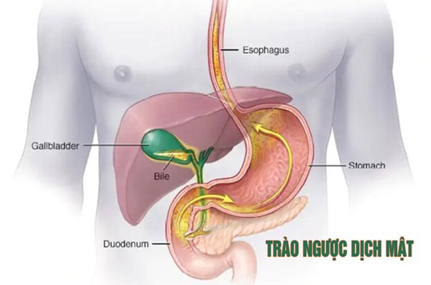 Nôn ra mật xanh cảnh báo bệnh lý gì? Có nghiêm trọng không?