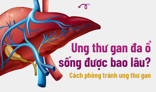 Ung thư gan đa ổ sống được bao lâu? Cách phòng tránh ung thư gan