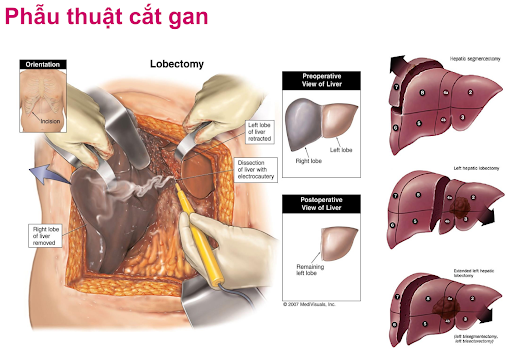 Ung thư gan đa ổ sống được bao lâu? Cách phòng tránh ung thư gan