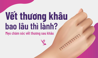 Vết thương khâu bao lâu thì lành? Mẹo chăm sóc vết thương sau khâu