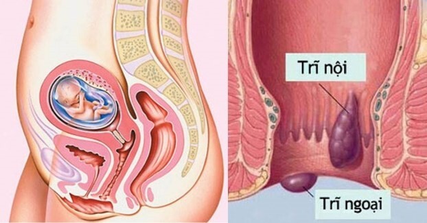 Giải đáp nhanh: Bệnh trĩ ở nữ giới có gì đặc biệt?