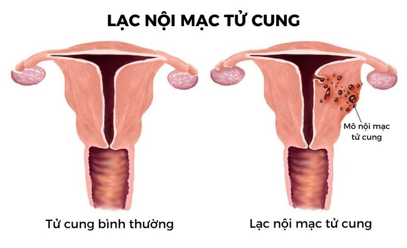 Bạn có biết: Đau bụng kinh làm gì cho đỡ đau?