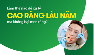 Làm thế nào để xử lý cao răng lâu năm mà không hại men răng?