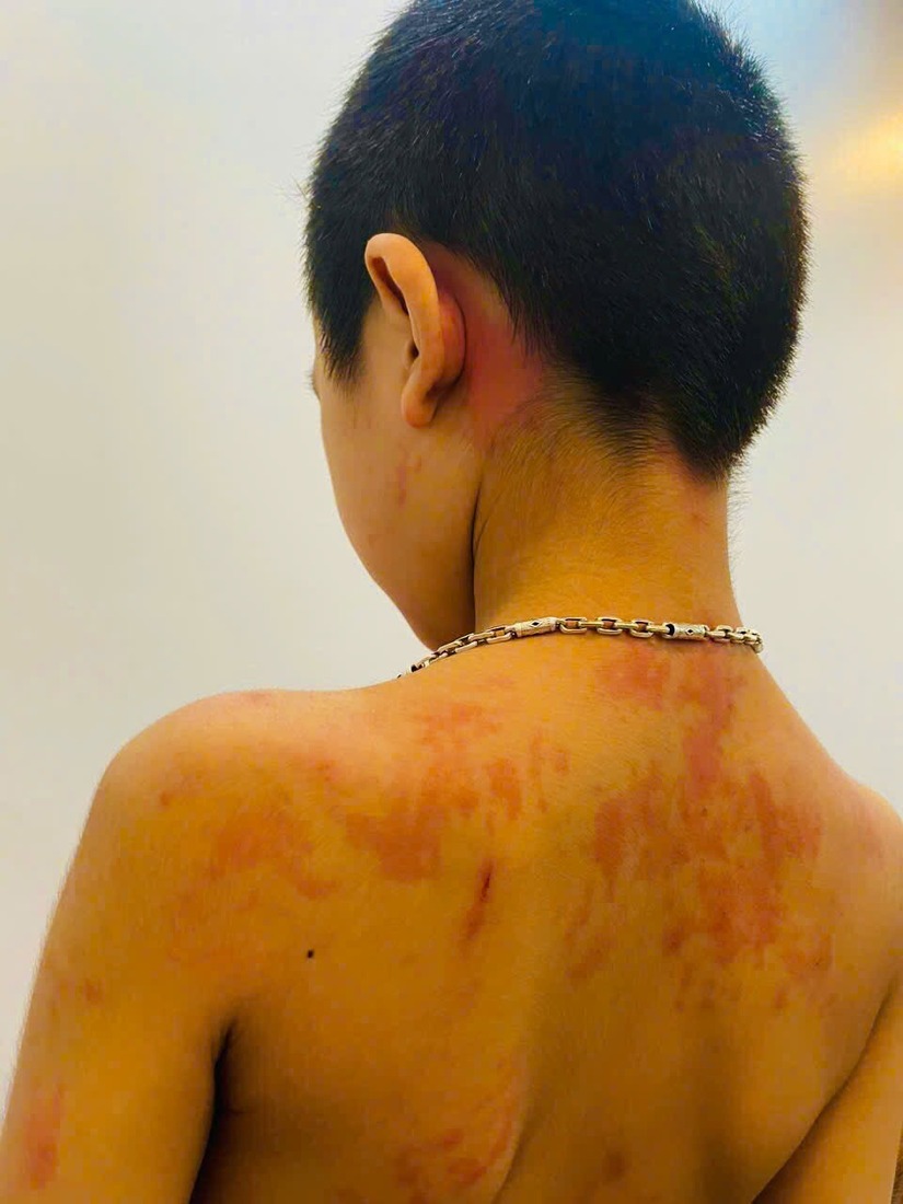 Tự ý cho con uống 11 loại thuốc để chữa ho, trẻ sốc phản vệ nguy kịch