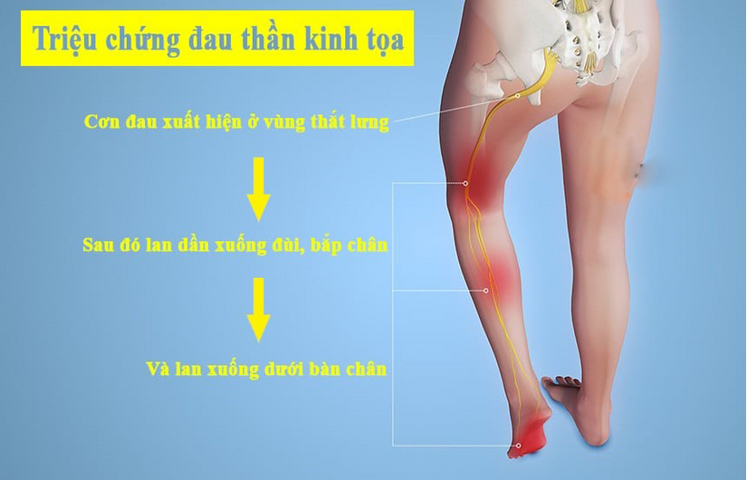 Nhận biết rõ các triệu chứng đau dây thần kinh tọa để điều trị