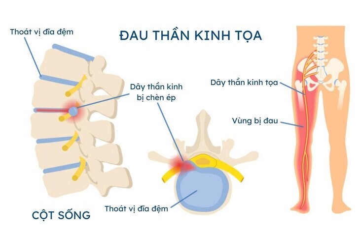 Nhận biết rõ các triệu chứng đau dây thần kinh tọa để điều trị