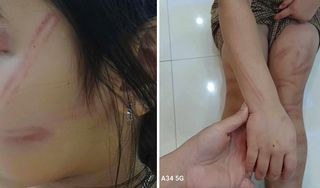 Vụ nhóm trẻ mầm non bị đánh bầm tím khắp người ở Nghệ An: Rút quyết định tạm đình chỉ giáo viên