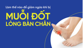 Làm thế nào để giảm ngứa khi bị muỗi đốt lòng bàn chân?