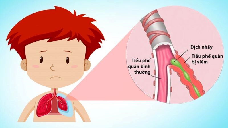 Tìm hiểu: Viêm tiểu phế quản cấp ở trẻ em thời điểm giao mùa