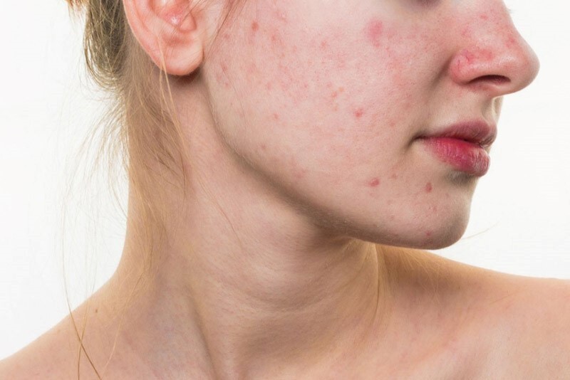 Giải đáp nhanh: Dị ứng da không nên ăn gì?