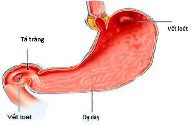 Vì sao bị đau bụng khi đói? Lời khuyên từ chuyên gia