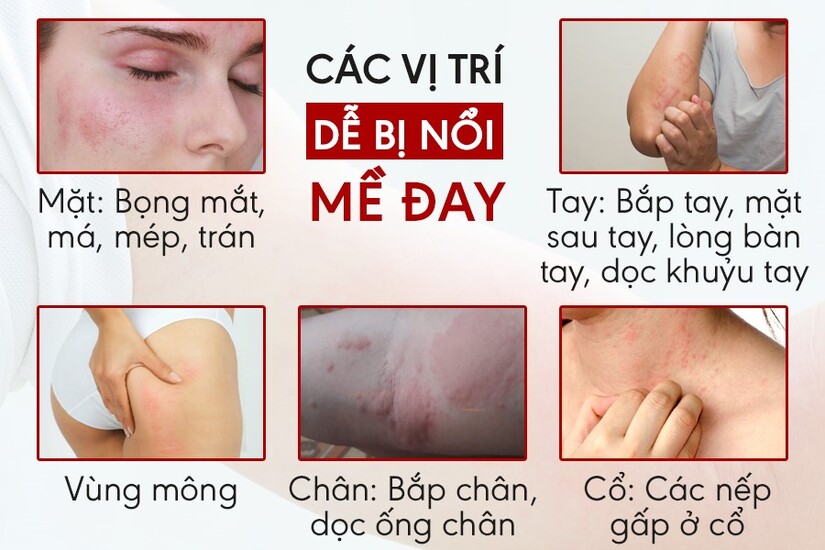 Chữa mề đay bằng mẹo có hiệu quả không? Những điều cần lưu ý