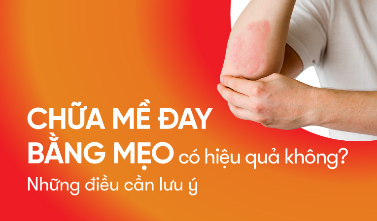 Chữa mề đay bằng mẹo có hiệu quả không? Những điều cần lưu ý