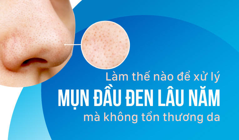 Làm thế nào để xử lý mụn đầu đen lâu năm mà không tổn thương da