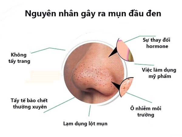 Làm thế nào để xử lý mụn đầu đen lâu năm mà không tổn thương da