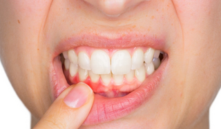 Nhiệt miệng chân răng: Nguyên nhân, triệu chứng và biện pháp điều trị