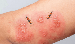 Giải đáp nhanh thắc mắc: Kiến ba khoang đốt có để lại sẹo không?