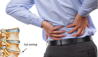 Bệnh gai cột sống thắt lưng – Giải pháp điều trị ít người biết!