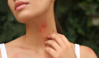 Làm thế nào để xử lý khi bị côn trùng cắn nổi mụn nước?