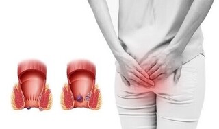 Giải đáp nhanh: Người bị trĩ nội nên kiêng gì?