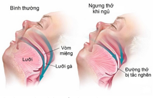 Dấu hiệu cảnh báo hội chứng nguy hiểm ngưng thở khi ngủ