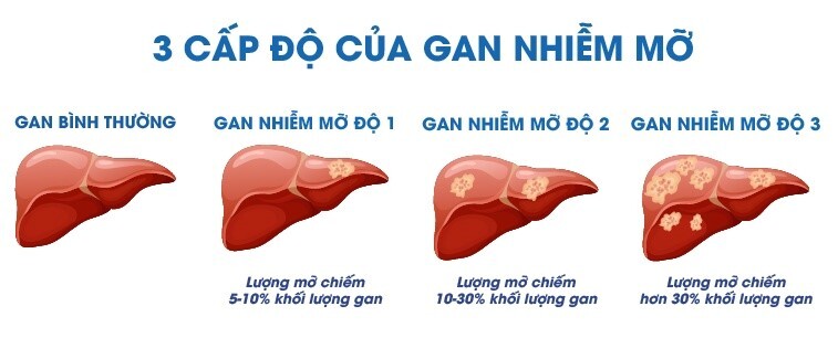 Gan nhiễm mỡ độ 1 là gì? Uống thuốc gì để điều trị?