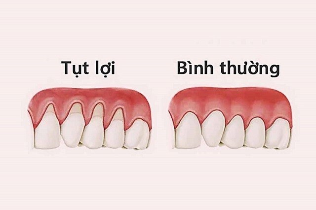 Bị tụt lợi nên uống thuốc gì Chăm sóc răng miệng để ngăn ngừa tụt lợi