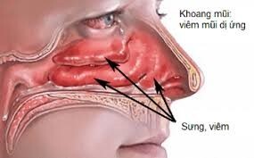 Giải đáp: Viêm mũi dị ứng có chữa khỏi được không?