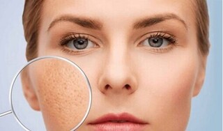 Da nhờn, lỗ chân lông to: Nguyên nhân và cách khắc phục