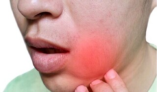Viêm lợi sưng má: Đừng chủ quan kẻo ân hận!