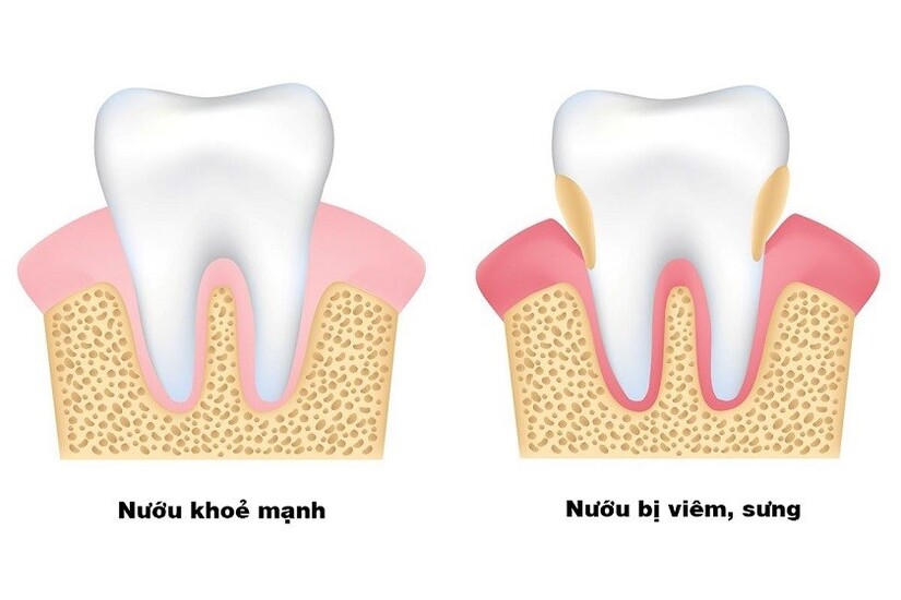 Viêm lợi sưng má: Đừng chủ quan kẻo ân hận!