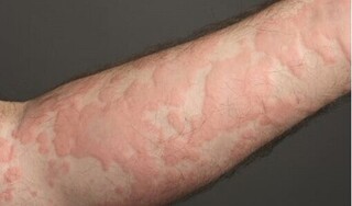 Nổi mẩn ngứa thành mảng khắp người: Có cách nào giảm ngứa nhanh?