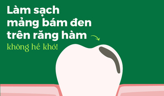 Làm sạch mảng bám đen trên răng hàm không hề khó!