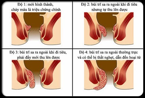 Đau trĩ nội có nguy hiểm không? Cách nhận biết và điều trị