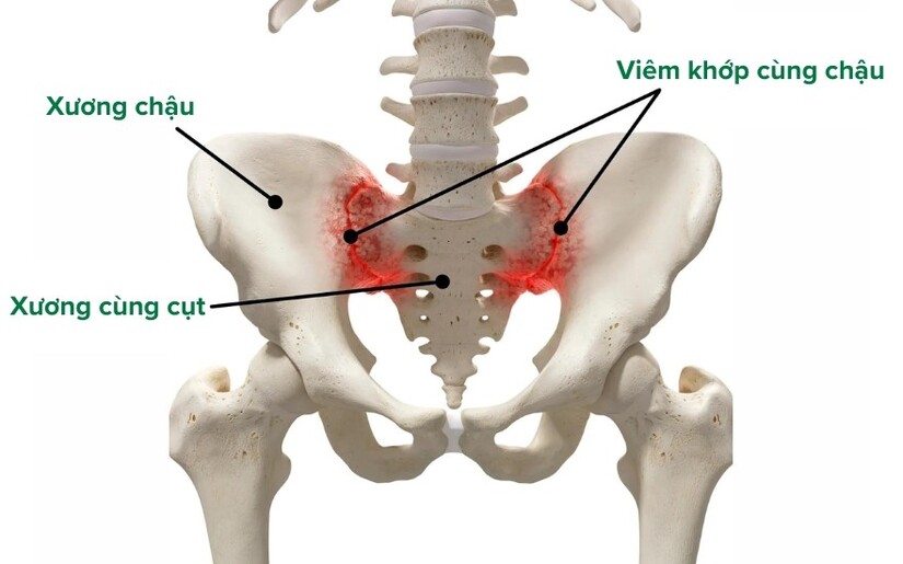 Tìm kiếm giải pháp hiệu quả cho bệnh viêm khớp cùng chậu